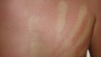 Handabdruck auf Sonnenbrand